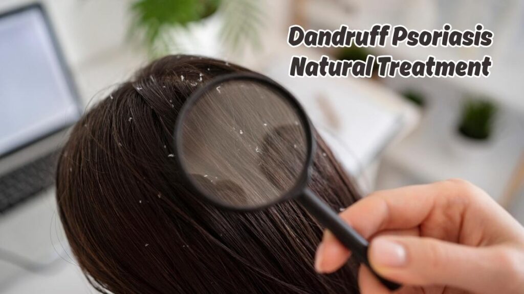 Dandruff Psoriasis Natural Treatment