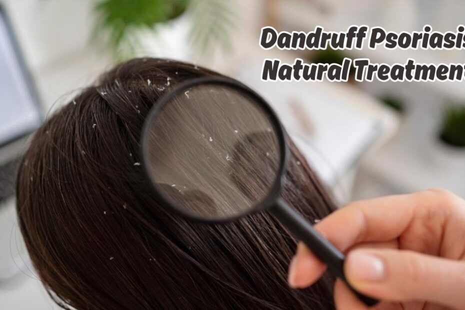 Dandruff Psoriasis Natural Treatment