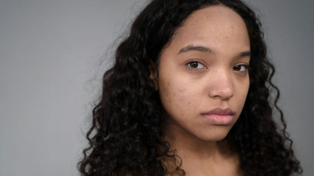 post-inflammatory hyperpigmentation